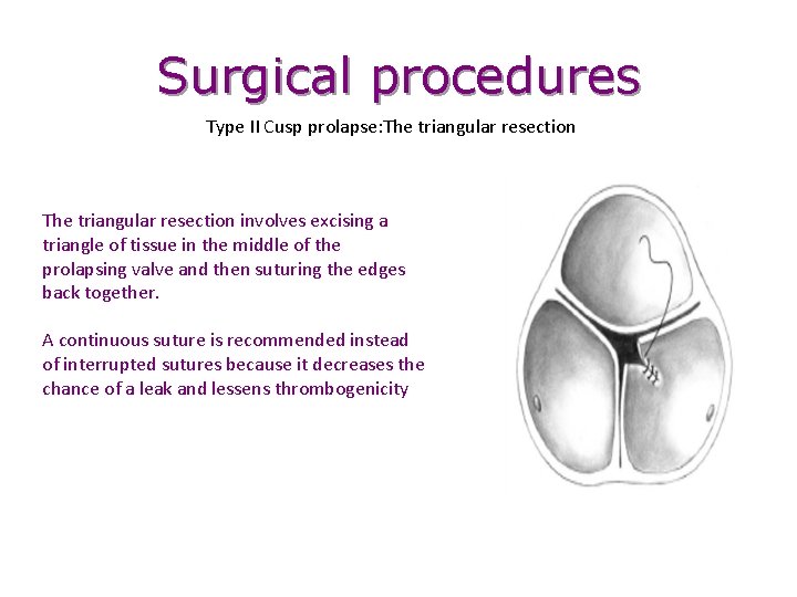 Surgical procedures Type II Cusp prolapse: The triangular resection involves excising a triangle of