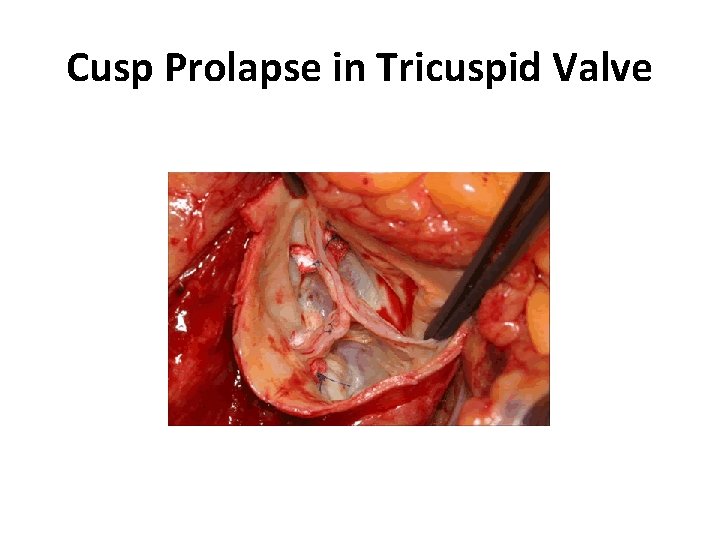 Cusp Prolapse in Tricuspid Valve 