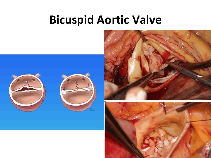Bicuspid Aortic Valve 