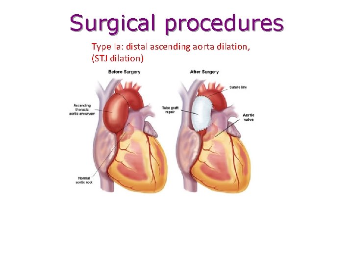 Surgical procedures Type Ia: distal ascending aorta dilation, (STJ dilation) 