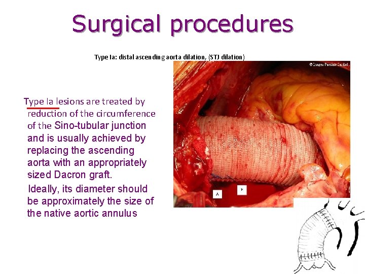 Surgical procedures Type Ia: distal ascending aorta dilation, (STJ dilation) Type Ia lesions are