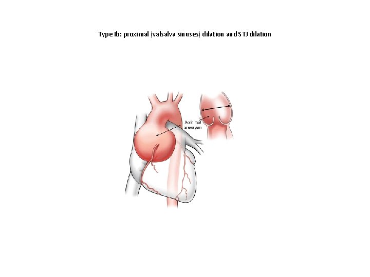 Type Ib: proximal (valsalva sinuses) dilation and STJ dilation 