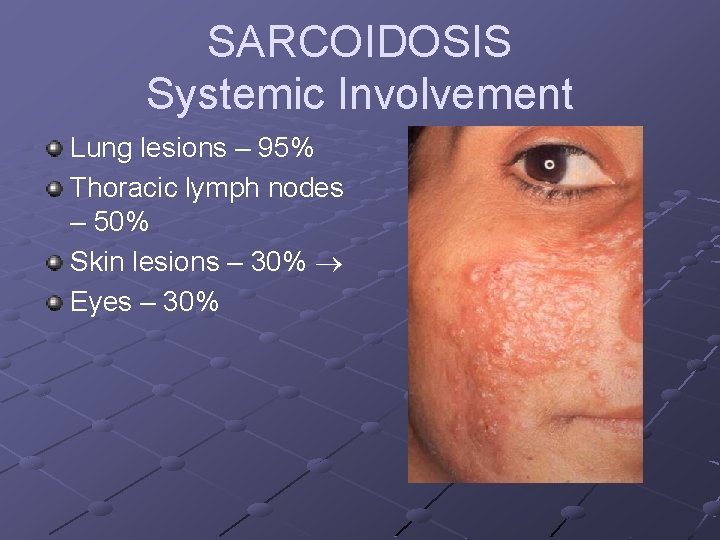 SARCOIDOSIS Systemic Involvement Lung lesions – 95% Thoracic lymph nodes – 50% Skin lesions