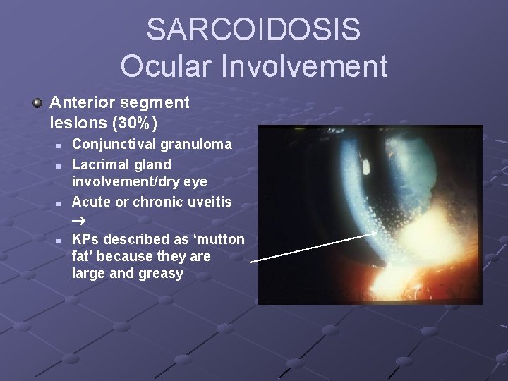 SARCOIDOSIS Ocular Involvement Anterior segment lesions (30%) n n Conjunctival granuloma Lacrimal gland involvement/dry