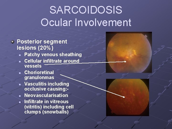 SARCOIDOSIS Ocular Involvement Posterior segment lesions (20%) n n n Patchy venous sheathing Cellular