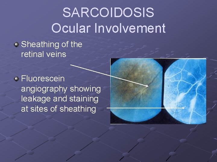 SARCOIDOSIS Ocular Involvement Sheathing of the retinal veins Fluorescein angiography showing leakage and staining
