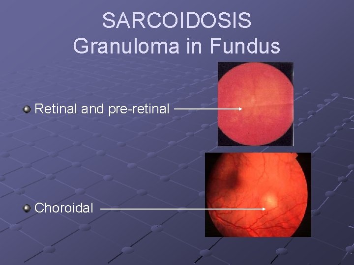 SARCOIDOSIS Granuloma in Fundus Retinal and pre-retinal Choroidal 