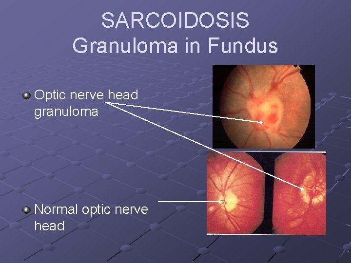 SARCOIDOSIS Granuloma in Fundus Optic nerve head granuloma Normal optic nerve head 