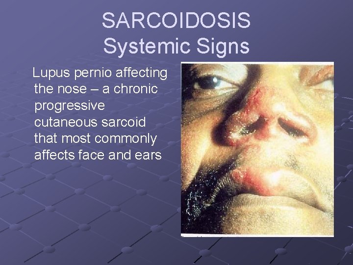 SARCOIDOSIS Systemic Signs Lupus pernio affecting the nose – a chronic progressive cutaneous sarcoid