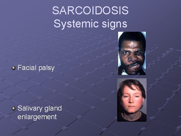 SARCOIDOSIS Systemic signs Facial palsy Salivary gland enlargement 