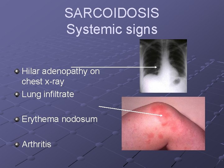 SARCOIDOSIS Systemic signs Hilar adenopathy on chest x-ray Lung infiltrate Erythema nodosum Arthritis 