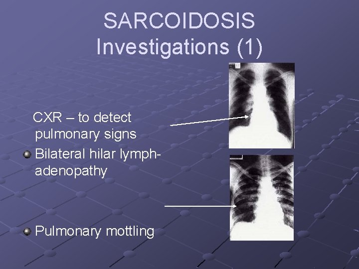 SARCOIDOSIS Investigations (1) CXR – to detect pulmonary signs Bilateral hilar lymphadenopathy Pulmonary mottling