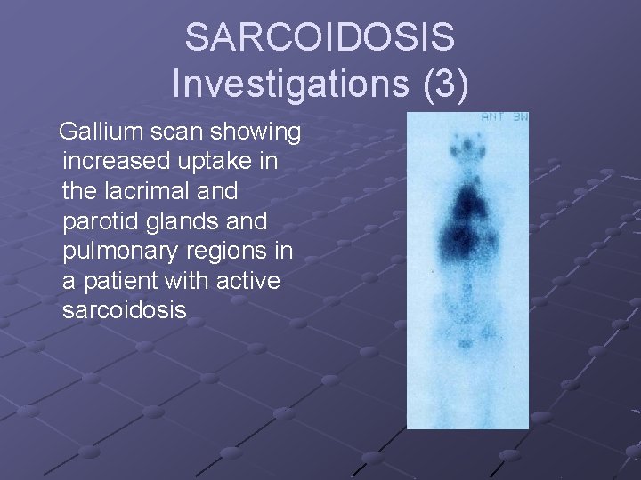 SARCOIDOSIS Investigations (3) Gallium scan showing increased uptake in the lacrimal and parotid glands