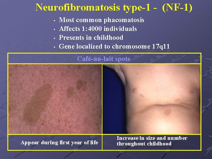 Neurofibromatosis type-1 - (NF-1) • • Most common phacomatosis Affects 1: 4000 individuals Presents