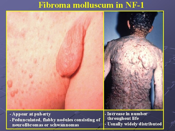 Fibroma molluscum in NF-1 Appear at puberty • Pedunculated, flabby nodules consisting of neurofibromas