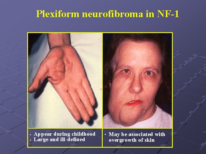 Plexiform neurofibroma in NF-1 • • Appear during childhood Large and ill-defined • May