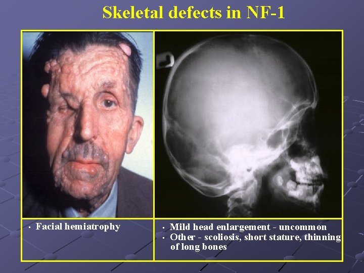 Skeletal defects in NF-1 • Facial hemiatrophy • • Mild head enlargement - uncommon