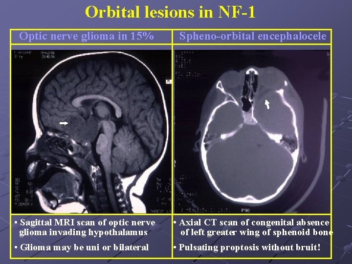 Orbital lesions in NF-1 Optic nerve glioma in 15% Spheno-orbital encephalocele • Sagittal MRI
