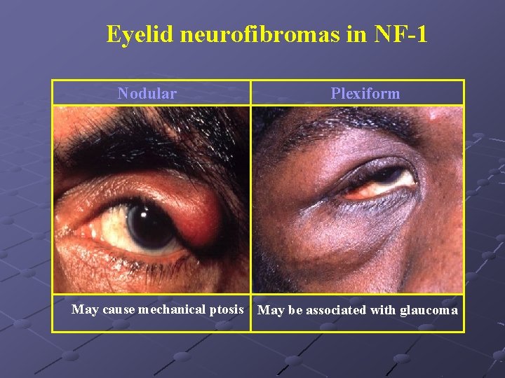 Eyelid neurofibromas in NF-1 Nodular Plexiform May cause mechanical ptosis May be associated with