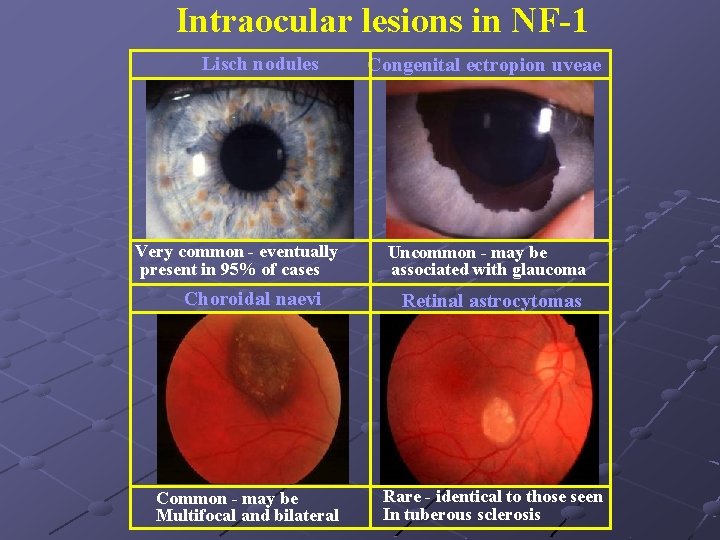 Intraocular lesions in NF-1 Lisch nodules Very common - eventually present in 95% of