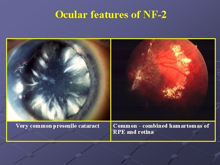 Ocular features of NF-2 Very common p- resenile cataract Common - combined hamartomas of