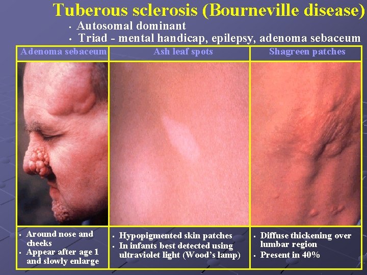 Tuberous sclerosis (Bourneville disease) • • Autosomal dominant Triad - mental handicap, epilepsy, adenoma