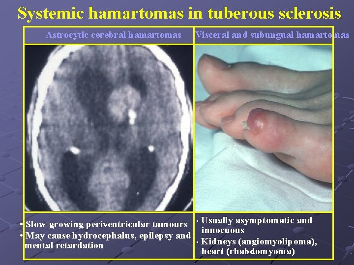 Systemic hamartomas in tuberous sclerosis Astrocytic cerebral hamartomas Visceral and subungual hamartomas • Slow-growing