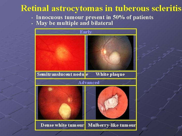 Retinal astrocytomas in tuberous scleritis • • Innocuous tumour present in 50% of patients