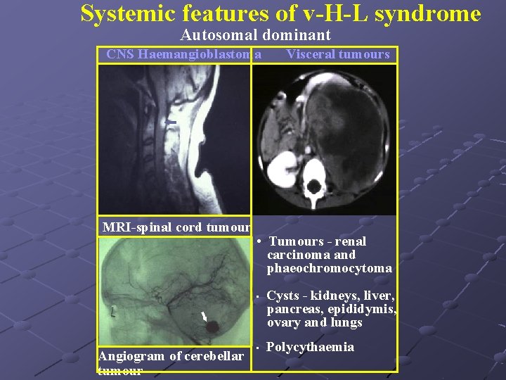 Systemic features of v-H-L syndrome Autosomal dominant CNS Haemangioblastoma MRI-spinal cord tumour • Tumours