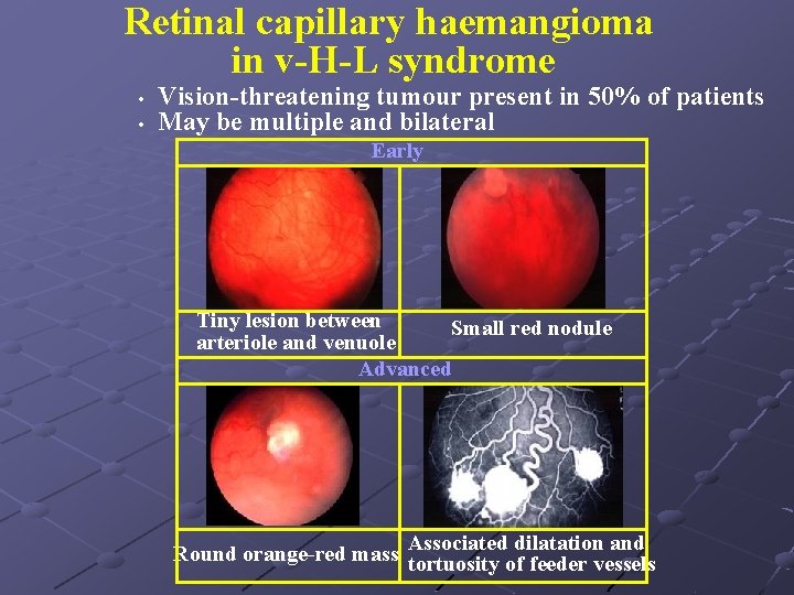 Retinal capillary haemangioma in v-H-L syndrome • • Vision-threatening tumour present in 50% of