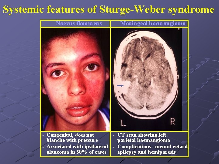 Systemic features of Sturge-Weber syndrome Naevus flammeus • • Congenital, does not blanche with