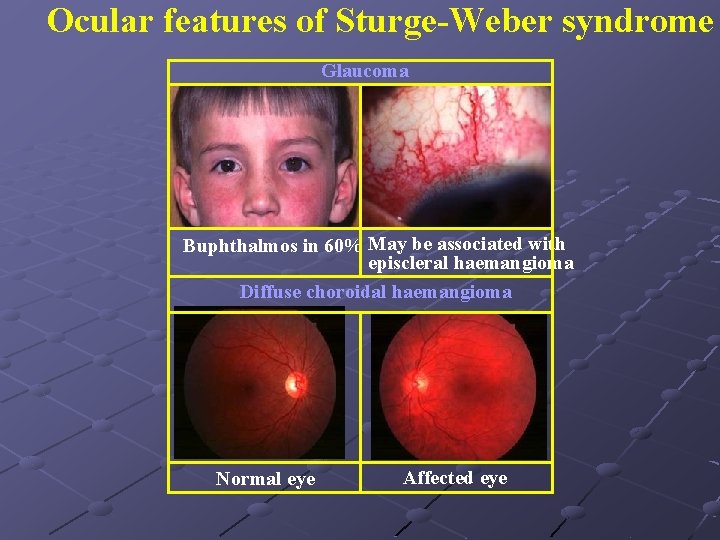 Ocular features of Sturge-Weber syndrome Glaucoma Buphthalmos in 60% May be associated with episcleral