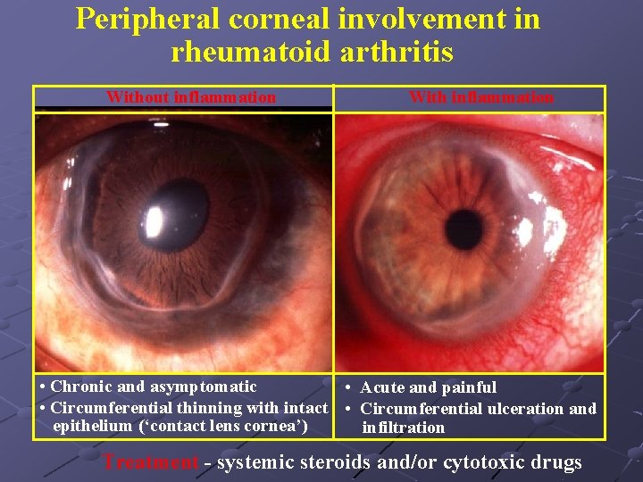 Peripheral corneal involvement in rheumatoid arthritis Without inflammation With inflammation • Chronic and asymptomatic