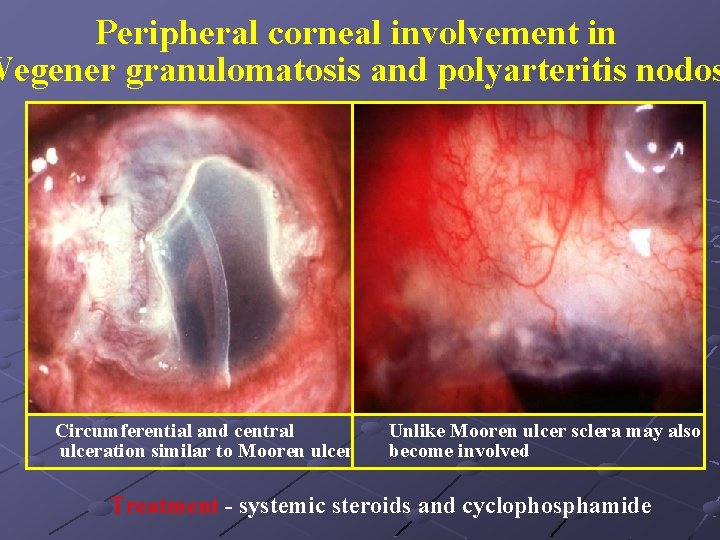 Peripheral corneal involvement in Wegener granulomatosis and polyarteritis nodos Circumferential and central ulceration similar