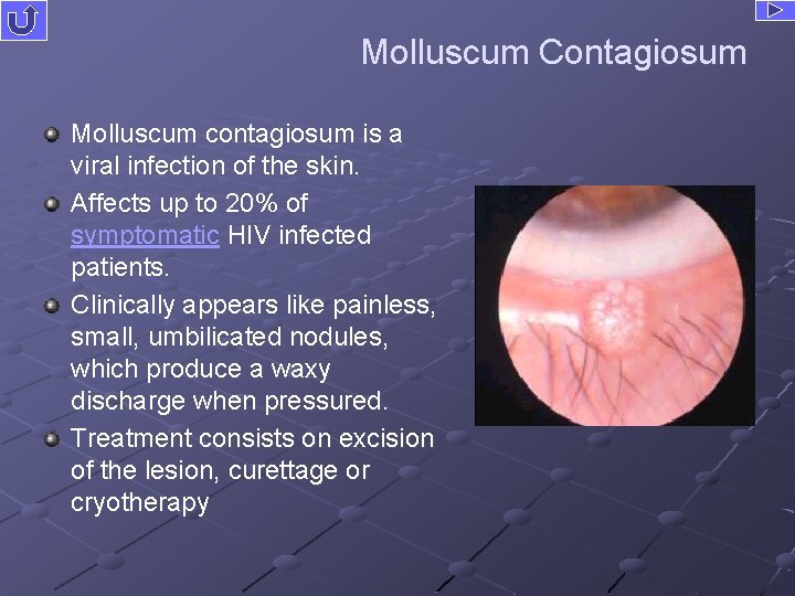 Molluscum Contagiosum Molluscum contagiosum is a viral infection of the skin. Affects up to