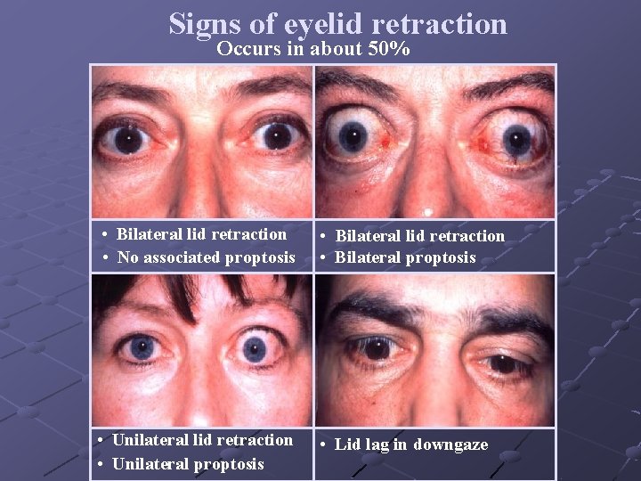 Signs of eyelid retraction Occurs in about 50% • Bilateral lid retraction • No