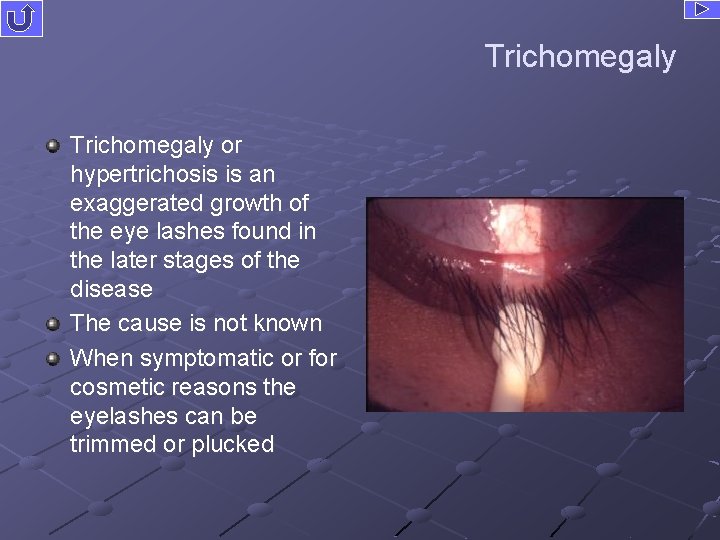 Trichomegaly or hypertrichosis is an exaggerated growth of the eye lashes found in the