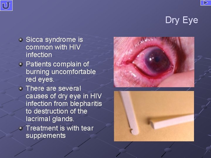 Dry Eye Sicca syndrome is common with HIV infection Patients complain of burning uncomfortable