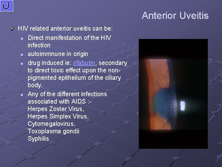 Anterior Uveitis HIV related anterior uveitis can be: n Direct manifestation of the HIV