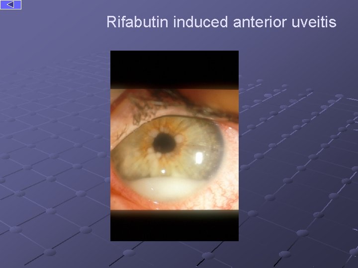 Rifabutin induced anterior uveitis 