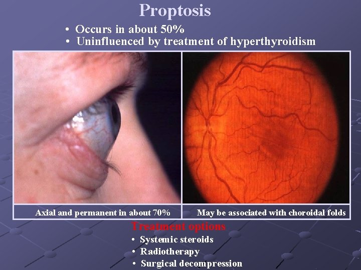 Proptosis • Occurs in about 50% • Uninfluenced by treatment of hyperthyroidism Axial and