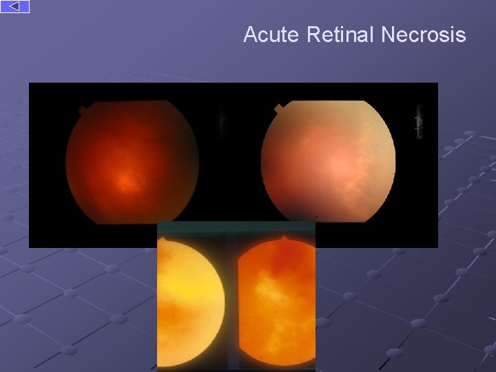 Acute Retinal Necrosis 