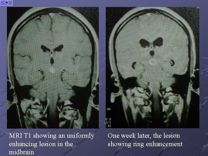 MRI T 1 showing an uniformly enhancing lesion in the midbrain One week later,