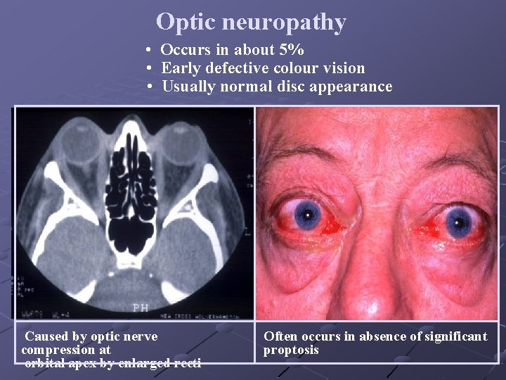 Optic neuropathy • Occurs in about 5% • Early defective colour vision • Usually