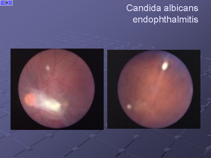 Candida albicans endophthalmitis 