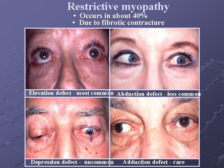 Restrictive myopathy • Occurs in about 40% • Due to fibrotic contracture Elevation defect