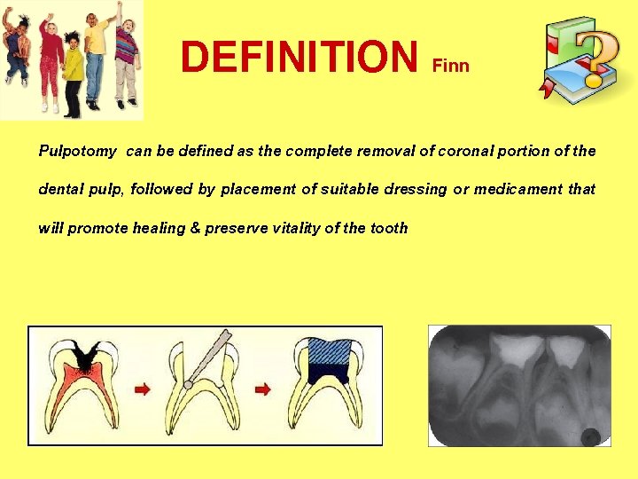 DEFINITION Finn Pulpotomy can be defined as the complete removal of coronal portion of DEFINITION Finn Pulpotomy can be defined as the complete removal of coronal portion of