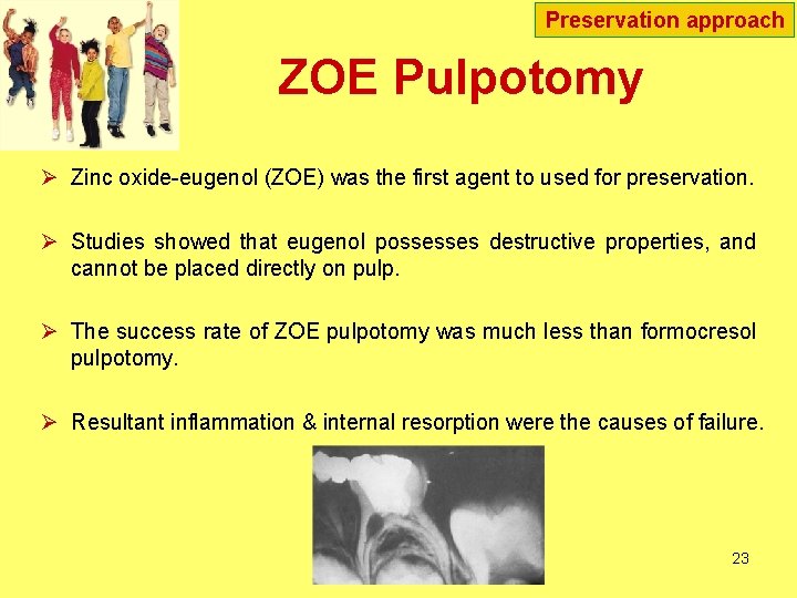 Preservation approach ZOE Pulpotomy Ø Zinc oxide-eugenol (ZOE) was the first agent to used Preservation approach ZOE Pulpotomy Ø Zinc oxide-eugenol (ZOE) was the first agent to used