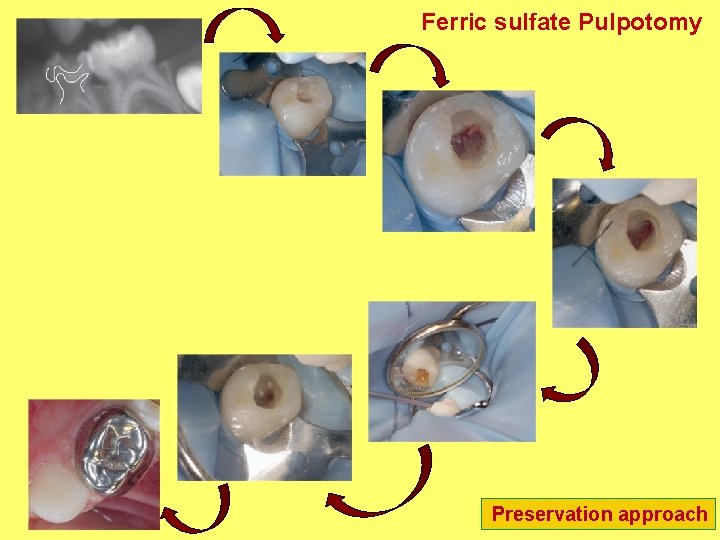 Ferric sulfate Pulpotomy Preservation approach Ferric sulfate Pulpotomy Preservation approach