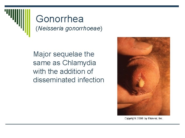 Gonorrhea (Neisseria gonorrhoeae) Major sequelae the same as Chlamydia with the addition of disseminated